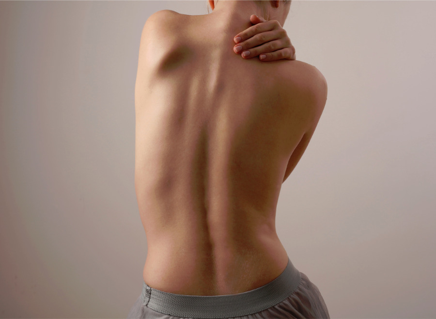 What Is Scoliosis? Advice From Your Chiropractor In West Vancouver