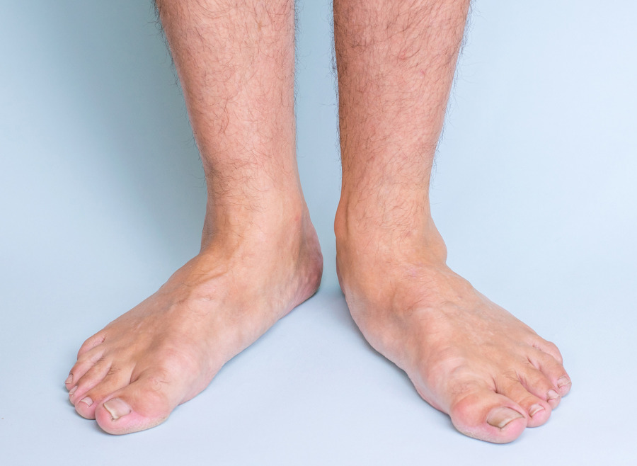 Is Having Fallen Arches Or Flat Feet A Bad Thing? Advice From Your West Vancouver Chiropractor
